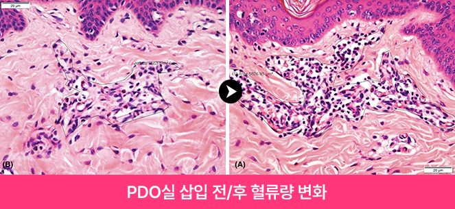 PDO실 삽입 전/후 혈류량 변화